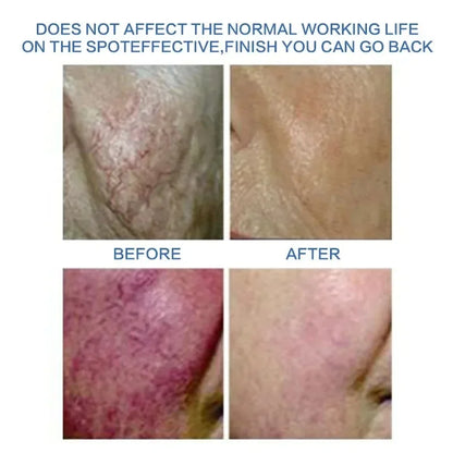 High Frequency Red Blood Vessel Vascular Removal 60W RF Facial Cleaner Beauty Machine Needle Spider Veins Remover Skincare Tool